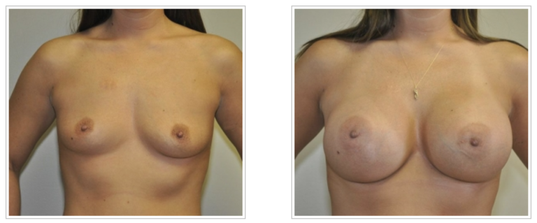 A woman's breasts before and after undergoing breast augmentation by Plastic Surgeon Dr. Jack Peterson.