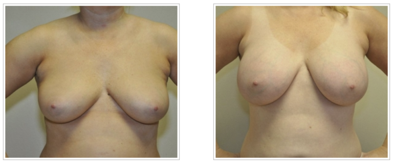 A woman's breasts underwent plastic surgery with Dr. Jack Peterson.
