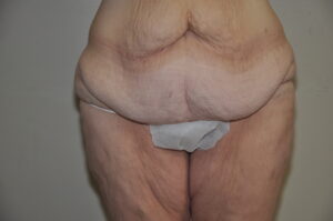 Patient 11 - Tummy Tuck Before