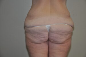 Patient 11 - Tummy Tuck After