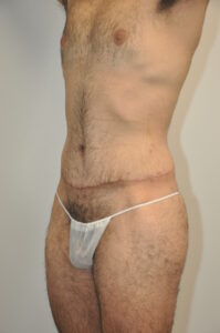 Patient 2 - Tummy Tuck Male After
