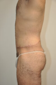 Patient 2 - Tummy Tuck Male After
