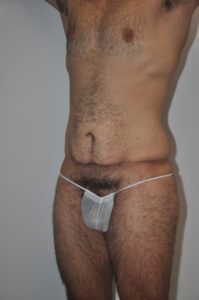 Patient 2 - Tummy Tuck Male Before