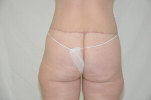 Patient 11 - Tummy Tuck After