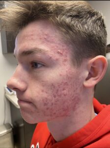 A young man with acne on his face.