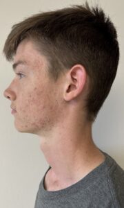 A young man with acne on his face.