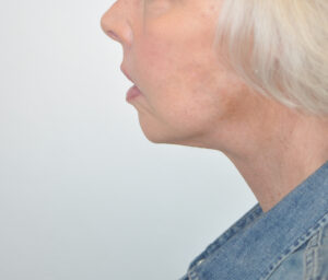 A woman's side view before a facelift.