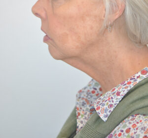 A woman's face with wrinkles before a facelift.