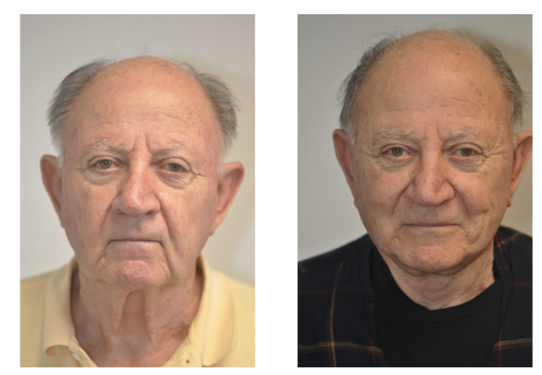 A before and after portrayal of Patient 5, showcasing the transformative effects of a face lift.