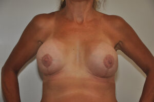 A topless woman with visible tan lines and two reconstructed breasts against a plain background.