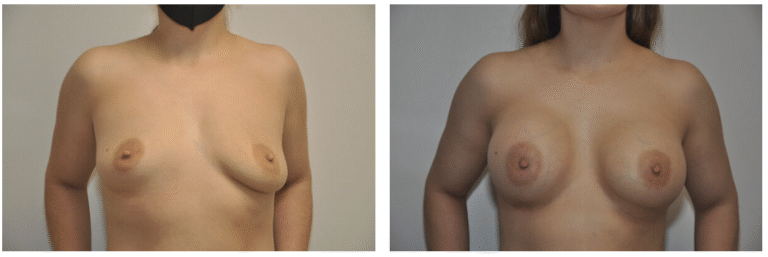 Side-by-side images showing Patient 29’s chest before (left) and after (right) Breast Augmentation surgery.