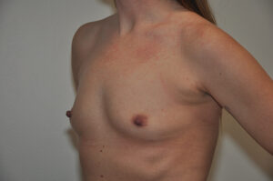 A person with visible red skin irritation or rash on the upper chest and shoulders, shown from the side with their upper torso exposed.