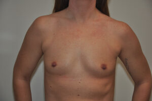 A person with visible scars on the chest, mild redness on the upper chest and shoulders, and a tattoo on the right upper arm, standing against a plain background.