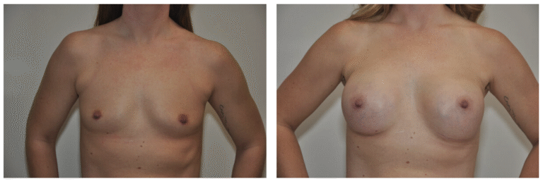 A 30-year-old patient’s torso is shown before (left) and after (right) Breast Augmentation surgery, highlighting a noticeable increase in breast size in the after photo.