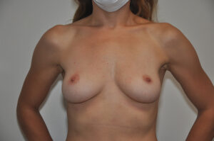 A woman wearing a mask stands topless against a plain background, with visible asymmetry in breast size and shape.