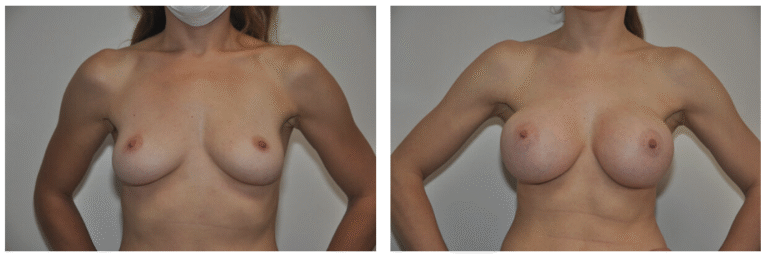 Side-by-side comparison of Patient 31's chest before and after Breast Augmentation, highlighting the enhanced breast size and improved contour in the after image.