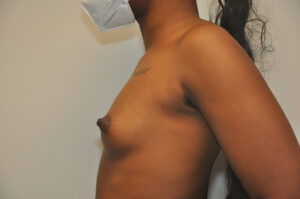 A person with a flat chest, exposed torso, and visible nipple, wearing a face mask, stands against a plain background.