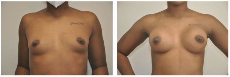 Side-by-side photos show Patient 32’s upper torso before (left) and after (right) Breast Augmentation surgery.