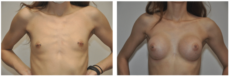Side-by-side photos of Patient 33 before and after Breast Augmentation. The left image shows a flat chest; the right displays enhanced breast size and improved shape.
