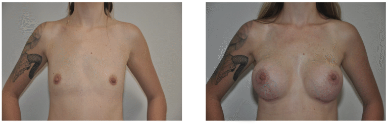Before and after photos of a 34-year-old patient highlighting changes in breast size and shape, likely following breast augmentation surgery.