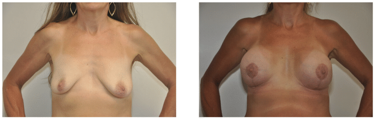 Side-by-side photos of Patient 35 before (left) and after (right) breast augmentation and reconstruction, highlighting noticeable differences in breast shape and size.
