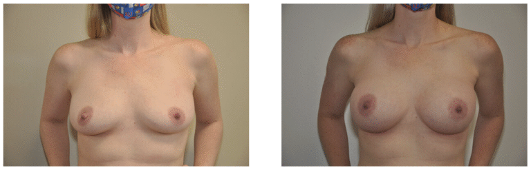 Side-by-side photos show Patient 36 before (left) and after (right) Breast Augmentation, highlighting noticeable changes in breast size and shape.