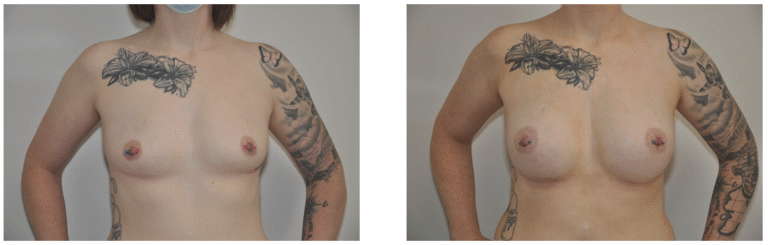 Two side-by-side photos of Patient 37, a woman with tattoos, showing her bare chest before and after Breast Augmentation surgery.