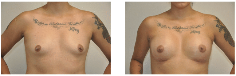 Side-by-side comparison showing Patient 38's chest before (left) and after (right) Breast Augmentation surgery. Tattoos on the upper chest and arms remain visible in both images.