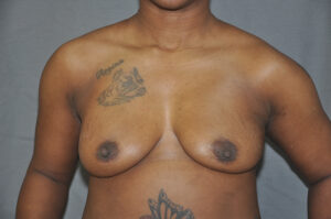 A person with uneven breasts, visible tattoos on the upper chest and lower torso, standing against a plain background.