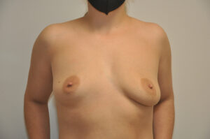 A person wearing a black face mask is shown topless against a plain background, displaying natural, asymmetrical breasts.