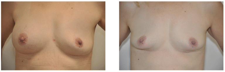 Before-and-after photos of a person's chest showing changes in breast shape and nipple position, possibly following breast implant removal or reconstruction.