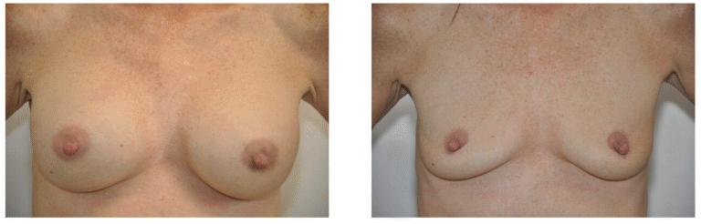 Side-by-side photos showing Patient 3's bare chest before (left) and after (right) breast reduction and breast implant removal surgery.