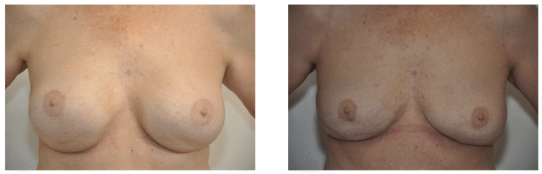 Side-by-side comparison of a person's chest showing preoperative (left) and postoperative (right) results following breast reduction and/or Breast Implant Removal surgery.
