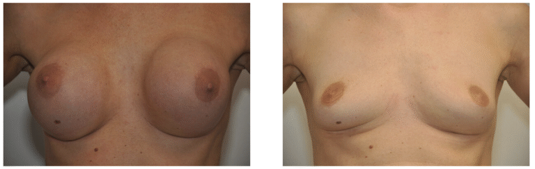 Side-by-side photos showing a person’s chest before and after Breast Implant Removal surgery, with implants present in the left image and absent in the right image.