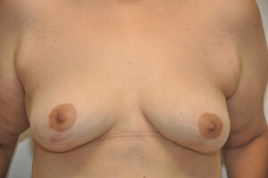 A person’s bare chest is shown from the front, displaying natural, unaltered breasts and nipples.
