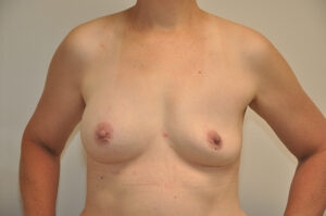 A person with visible scars on their chest, standing with their hands on their hips, photographed from the shoulders to the waist against a plain background.