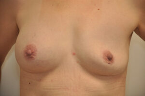 A close-up image of a person's bare chest showing post-surgical scars and changes in breast shape, possibly after a breast reconstruction or mastectomy.
