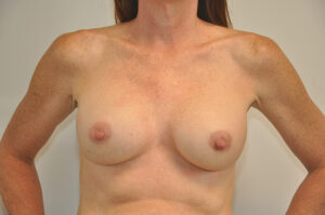 A woman with visible post-mastectomy breast reconstruction scars stands facing forward, her hands resting on her hips, against a plain background.