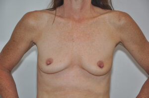 A topless woman with fair, freckled skin stands against a plain background, arms bent at her sides.