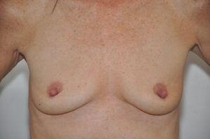 A person's bare chest and upper torso with some visible skin texture and pigmentation differences.