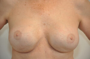 A close-up view of a person's bare chest and breasts, showing natural skin texture and coloration.