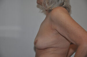 A side view of an older woman with gray hair and bare chest, showing a scar near her armpit and natural breast shape.