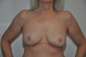 A woman with gray hair shows her bare chest, revealing a horizontal surgical scar below both breasts.