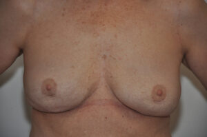 A person's bare chest showing natural breasts with a faint horizontal scar below the breasts, possibly indicative of prior surgery.