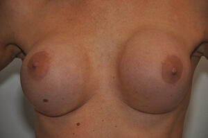 A close up of a woman's breast.
