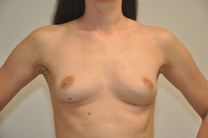 A person with a bare chest and arms positioned on hips, displaying natural skin texture and coloration, standing against a plain background.