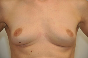 A close-up of a person's bare chest and torso, showing natural breasts with the arms slightly raised and skin tone variations visible.