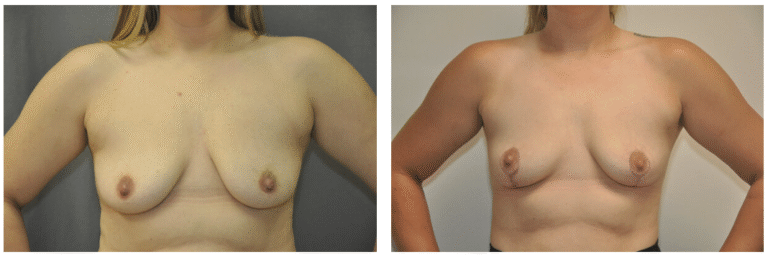 Side-by-side photos showing a breast lift patient’s chest before (left) and after (right) breast reduction surgery.