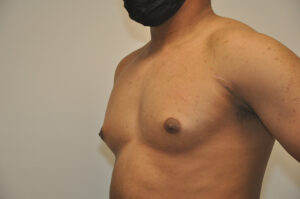 A person wearing a black face mask is shown from the shoulders to the waist, displaying a noticeable swelling in the chest area.