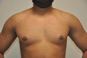 A person with a bare chest faces forward, wearing a black face mask. Faint scars are visible near both armpits.